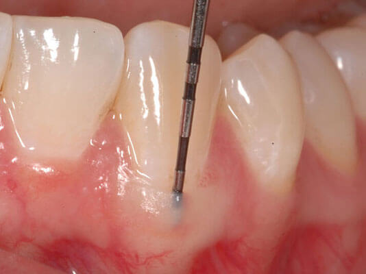 Cosmetic Periodontal Procedures - Dr. Suzanne Caudry